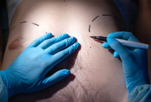 Doctor plastic surgeon makes marks with a felt tip pen for plastic surgery to correct male breast, close up. Gynecomastia Doctor plastic surgeon makes marks with a felt tip pen for plastic surgery to correct male breast, close up. Gynecomastia